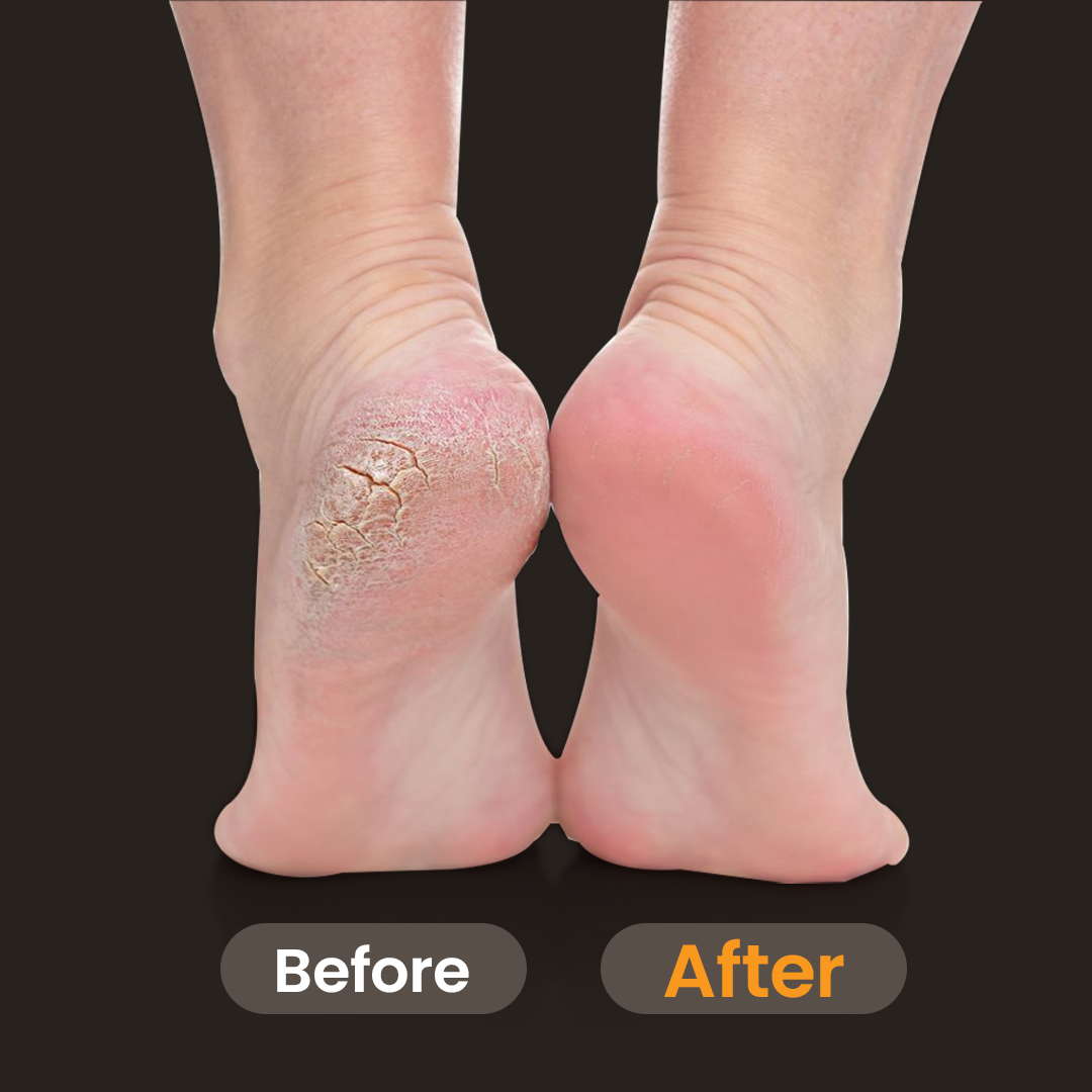 Airluxe PediSmooth Callus Remover for Feet